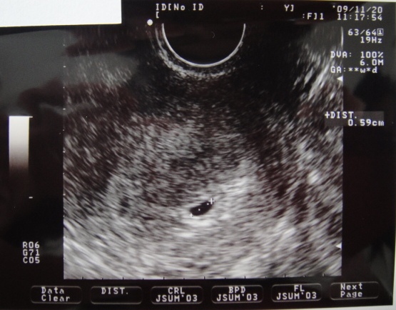 胎嚢 確認 いつ 医師監修 胎嚢と胎芽が確認できる時期は 見えない時の原因について マイナビウーマン子育て Amp Petmd Com